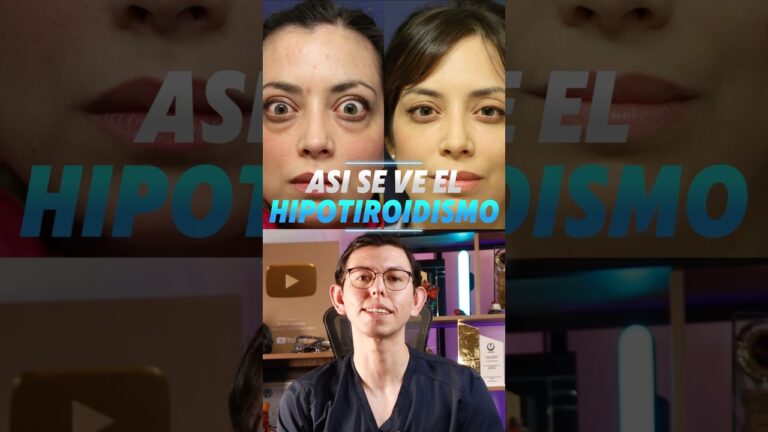grado de discapacidad por hipotiroidismo